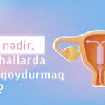 Spiral nədir? Hansı hallarda spiral qoydurmaq olmaz? - Drxanim.az